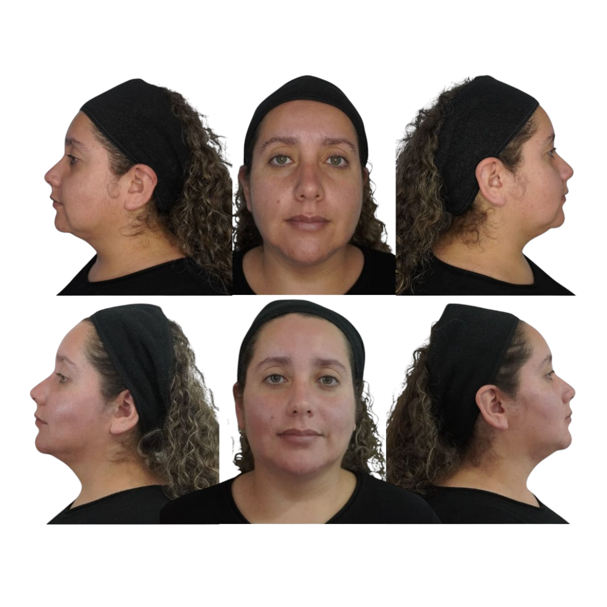 Caso de éxito 1 - Tratamiento de armonización facial