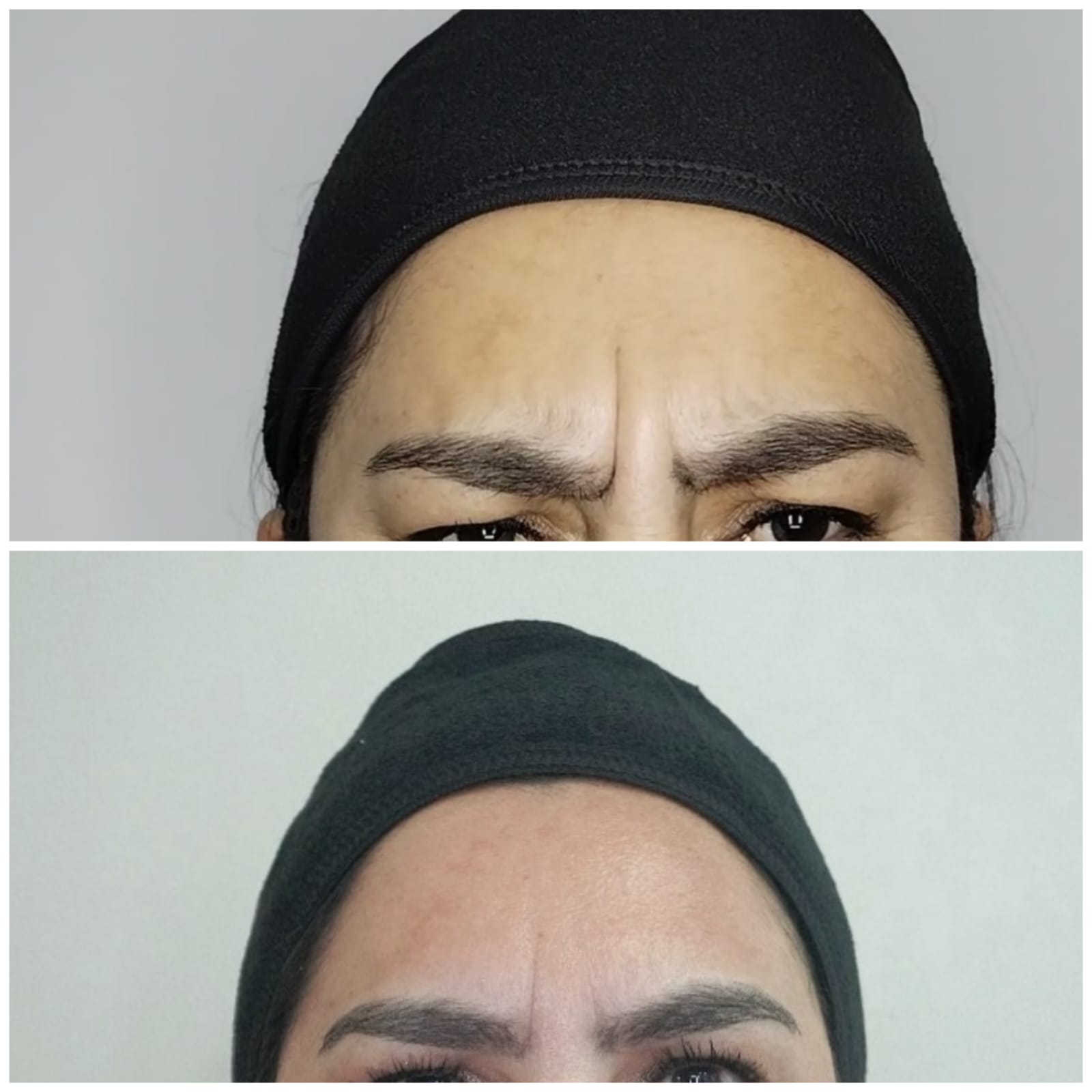 Caso de éxito 2 - Tratamiento de armonización facial