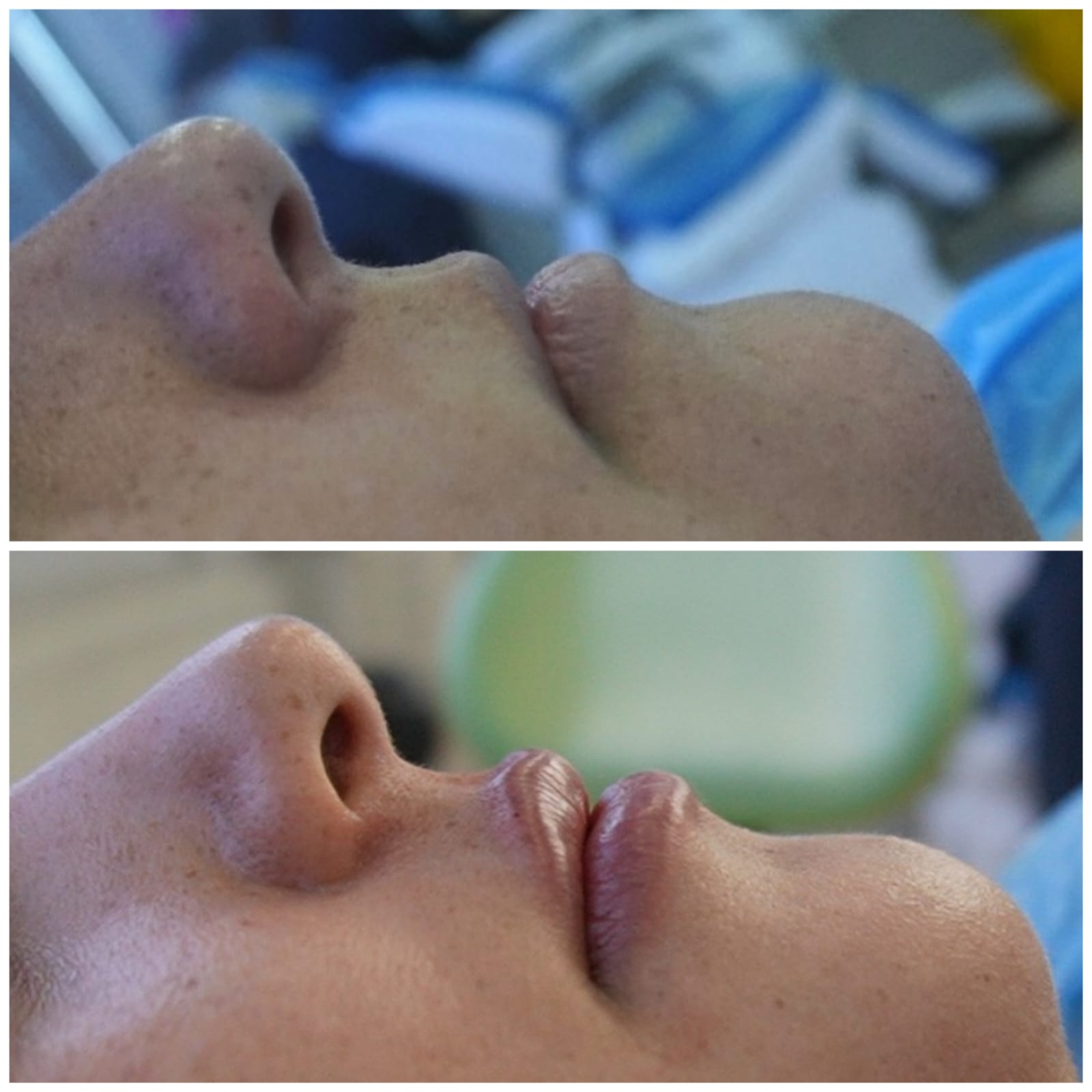 Caso de éxito 3 - Tratamiento de armonización facial